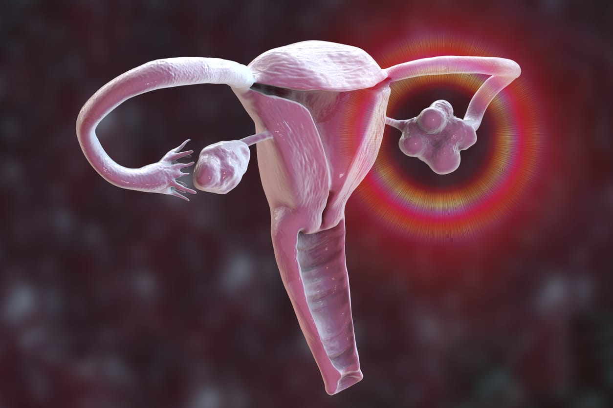 Illustrazione dell'ovaio policistico